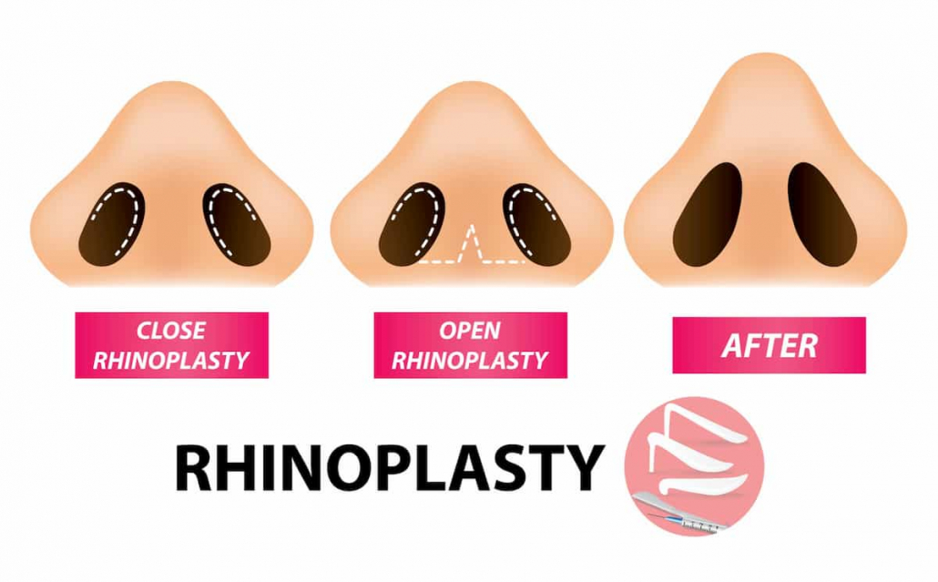 closed method of rhinoplasty